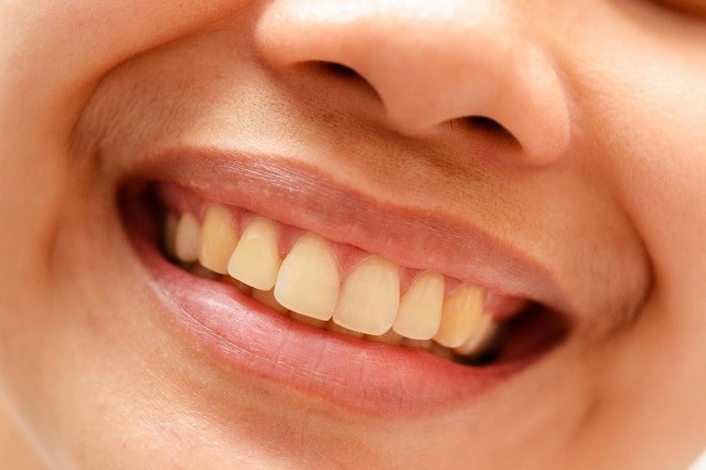 yellow-teeth